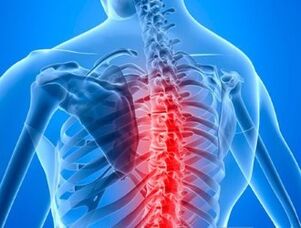 osteocondroza celei de-a 2-a părți a coloanei vertebrale, gradul 2